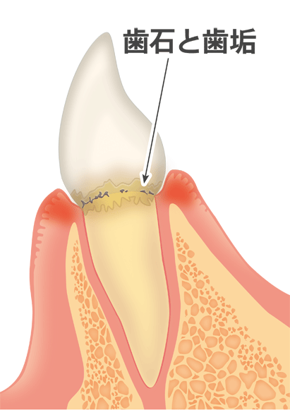 歯石と歯垢